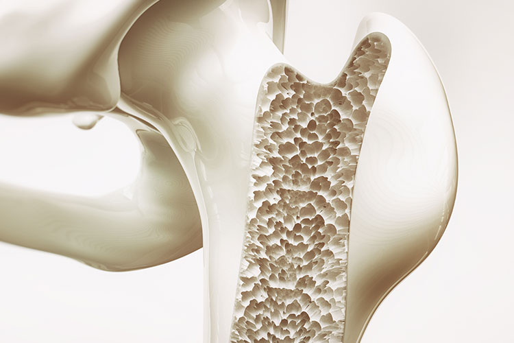 骨粗しょう症とは